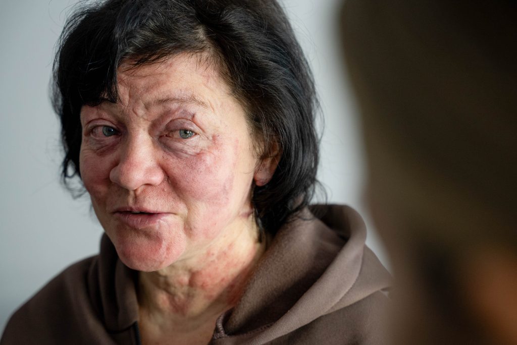 Стерти сліди війни: як харківський тату-майстер допомагає постраждалим від обстрілів Стерти сліди війни: як харківський тату-майстер допомагає постраждалим від обстрілів