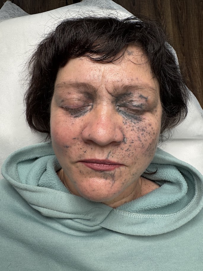 Стерти сліди війни: як харківський тату-майстер допомагає постраждалим від обстрілів Стерти сліди війни: як харківський тату-майстер допомагає постраждалим від обстрілів