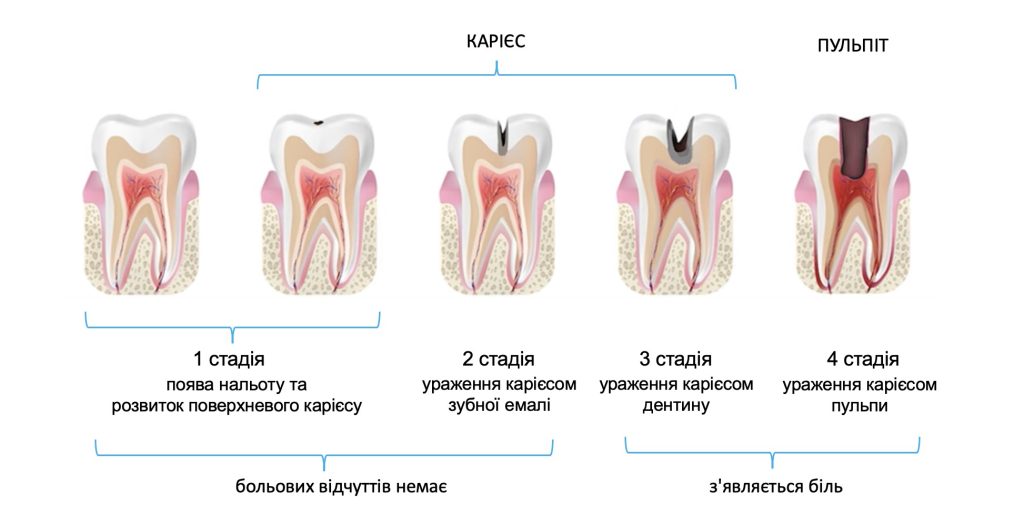 Що робити, якщо болить зуб? Що робити, якщо болить зуб?