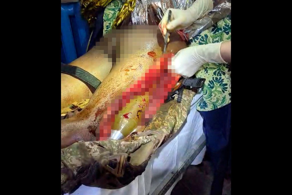 У пораненого бійця в нозі виявили протитанкову гранату У пораненого бійця в нозі виявили протитанкову гранату